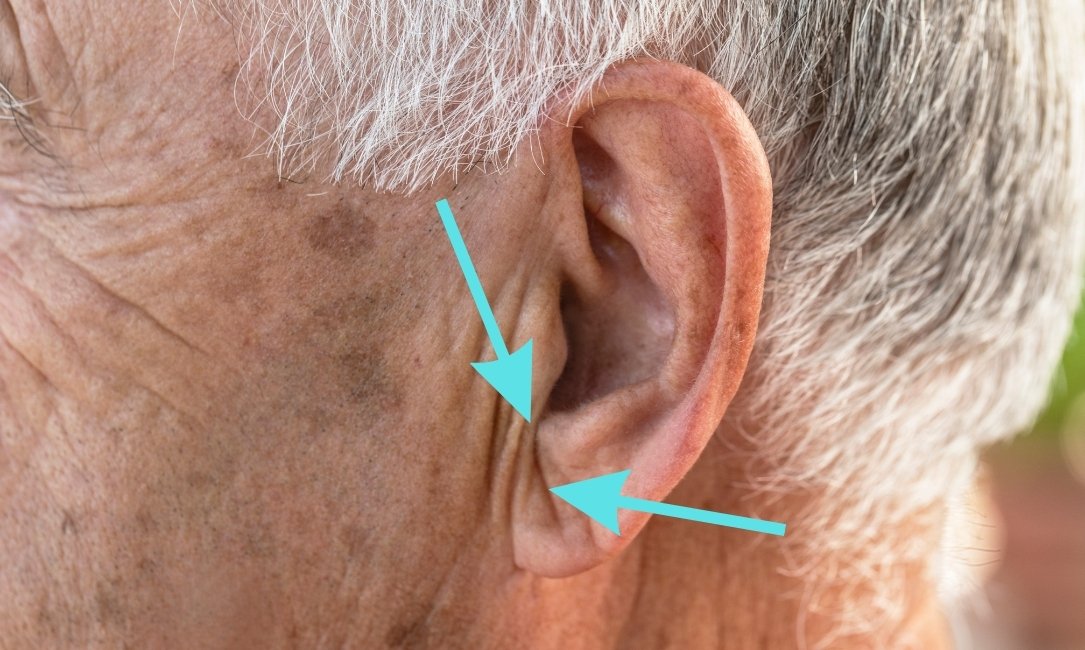 Sinal de Frank: o que é, causas e relação com doenças cardiovasculares